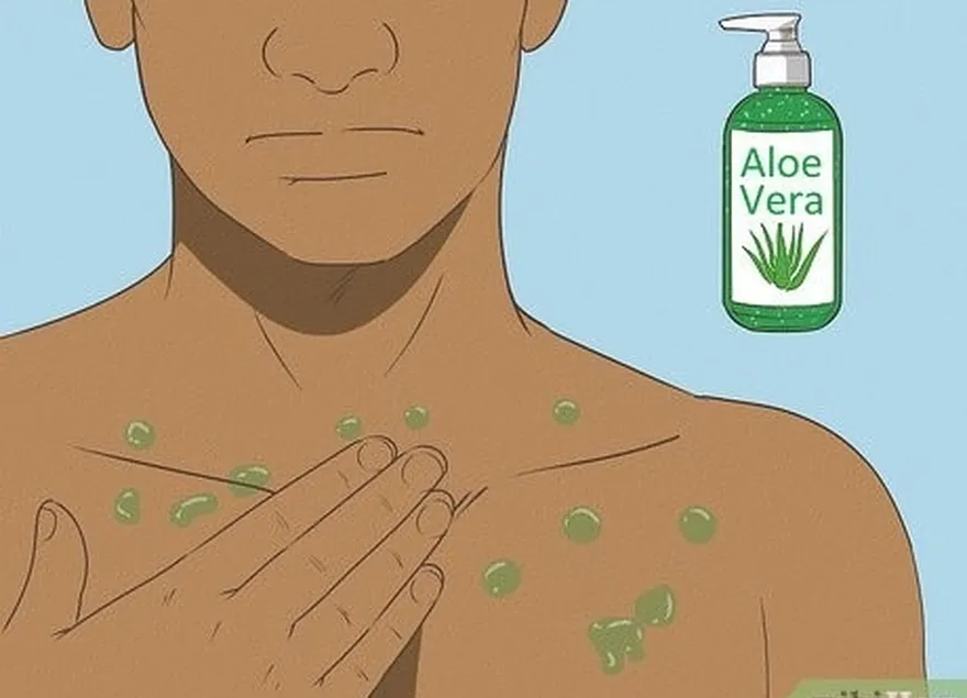 l'aloe vera apaise et hydrate la peau enflammée.