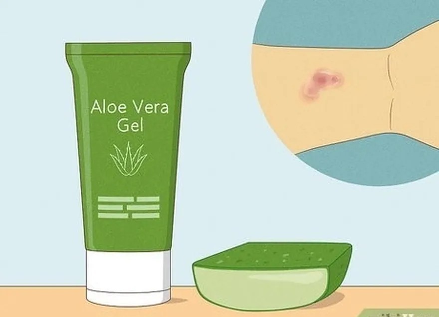 étape 7 appliquez de l'aloe vera sur votre éruption cutanée pour soulager les démangeaisons.