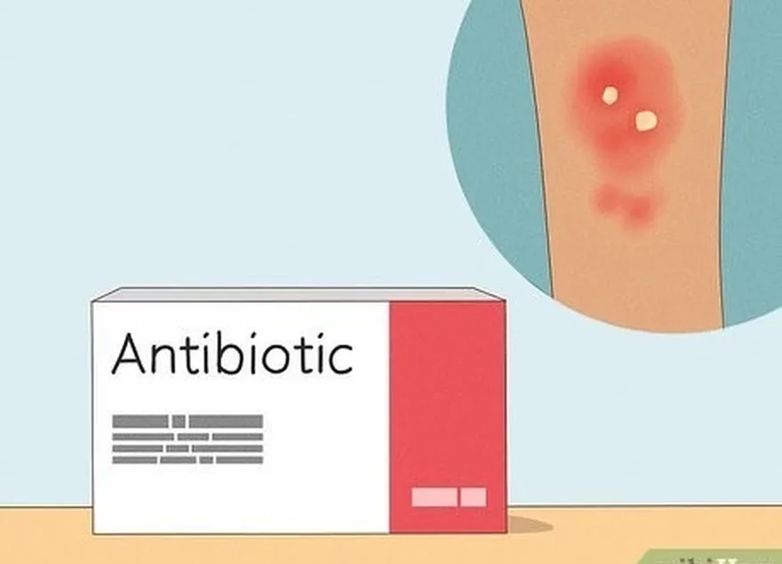 étape 3 prendre un antibiotique prescrit en cas d'infection.