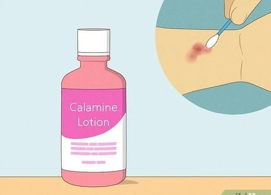 étape 2 appliquer la lotion à la calamine...