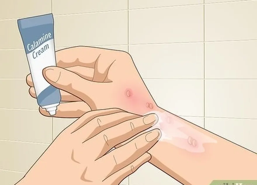 étape 2 utilisez une crème à la calamine ou à l'hydrocortisone pour soulager les démangeaisons.