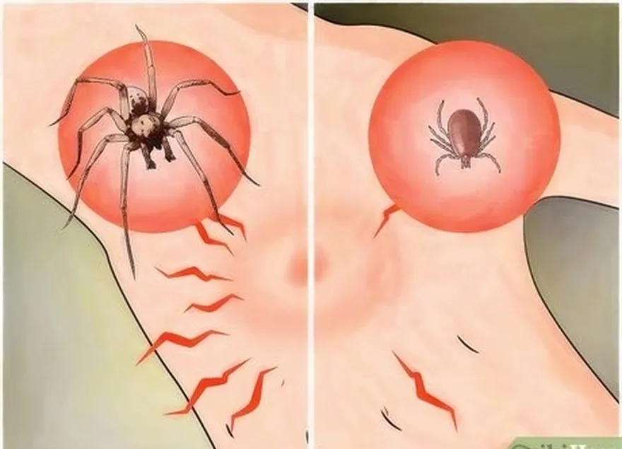 étape 3 don't confuse tick bites as spider bites.