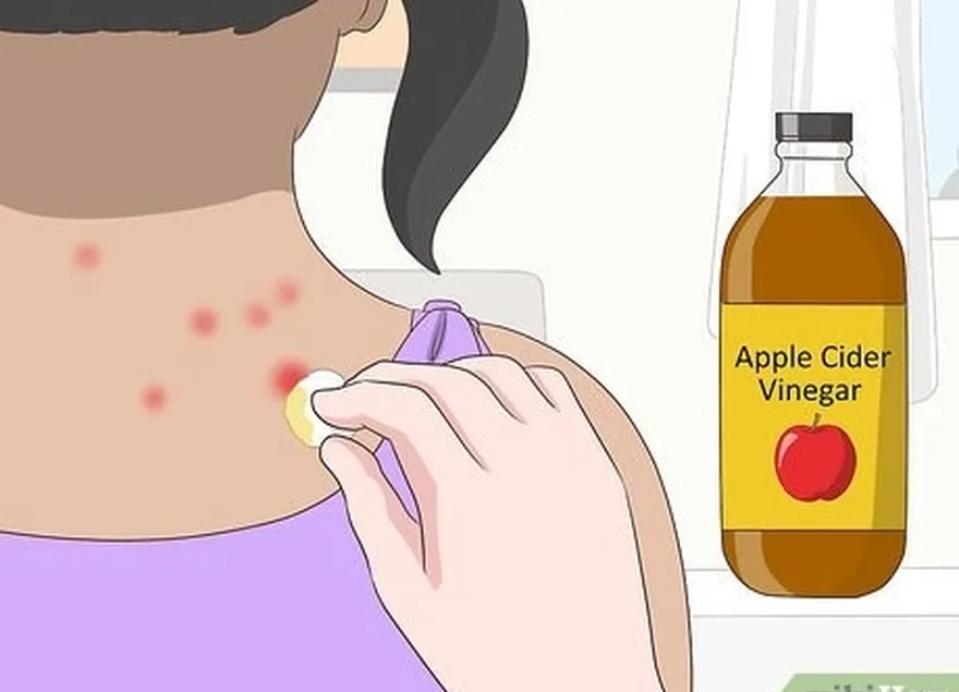 étape 4 appliquez du vinaigre de cidre de pomme sur la piqûre pour un remède maison naturel.