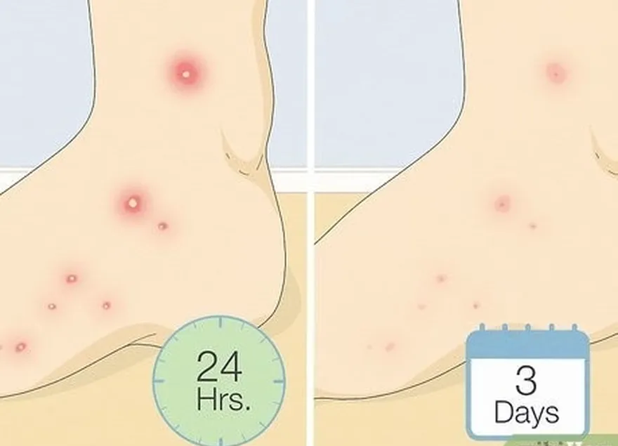 étape 2 une pustule se forme dans les 24 heures et disparaît au bout de 3 jours.