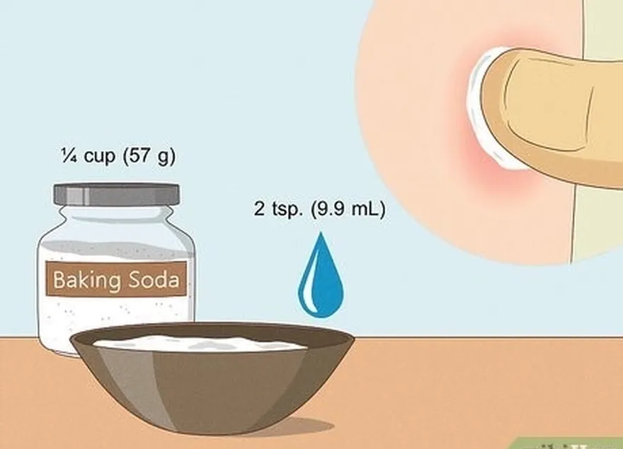 faites une pâte de bicarbonate de soude pour neutraliser le venin de la guêpe.