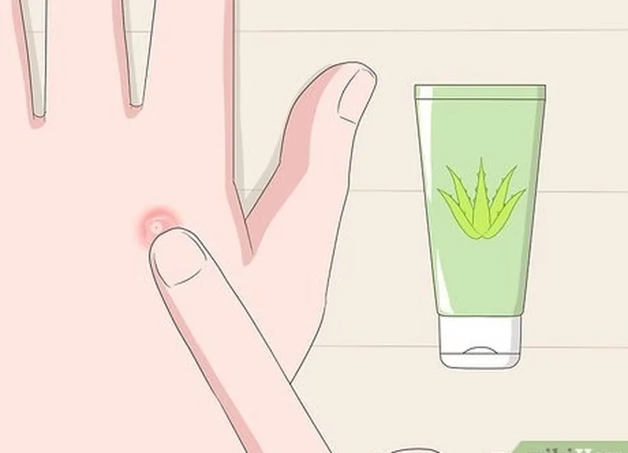 étape 4 utiliser de l'aloe vera si l'irritation persiste.