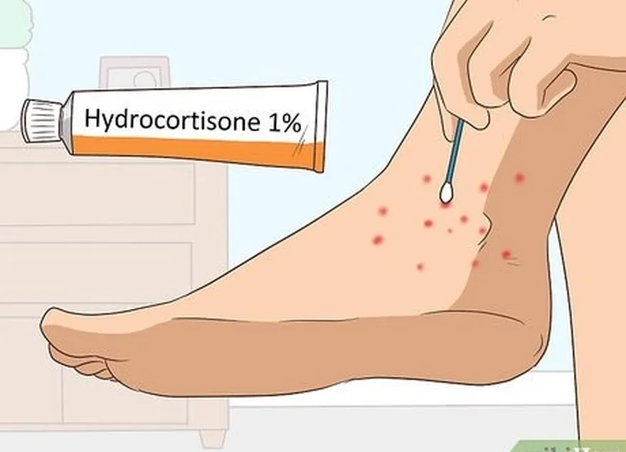 étape 2 : appliquez une crème à l'hydrocortisone pour soulager les démangeaisons.