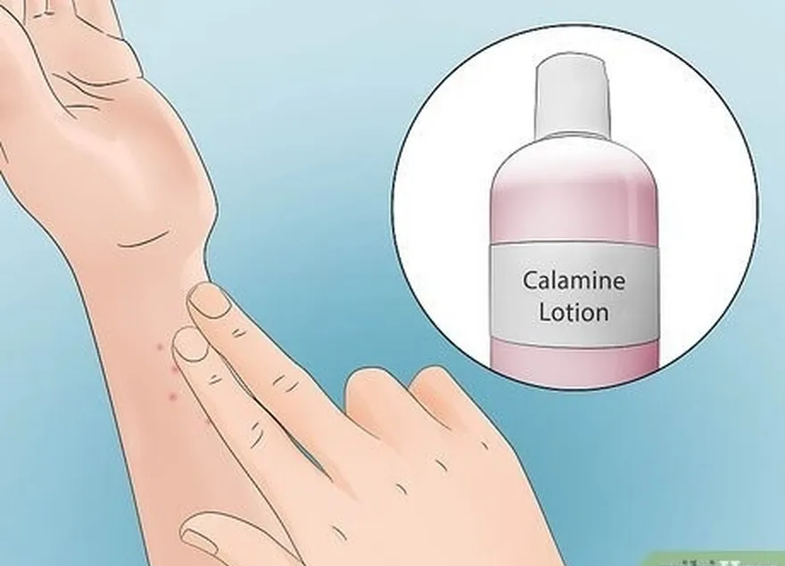 étape 2 appliquer une lotion à la calamine ou une crème à l'hydrocortisone.