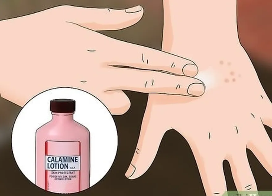 étape 3 utilisez une lotion à la calamine pour apaiser la peau affectée.