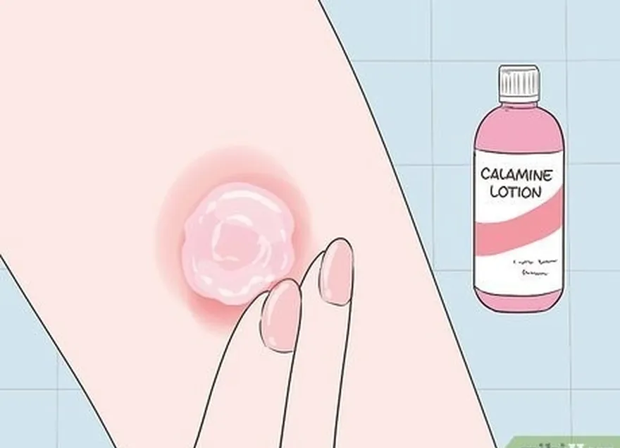 étape 1 frottez les ampoules avec une quantité de lotion à la calamine de la taille d'un petit pois.