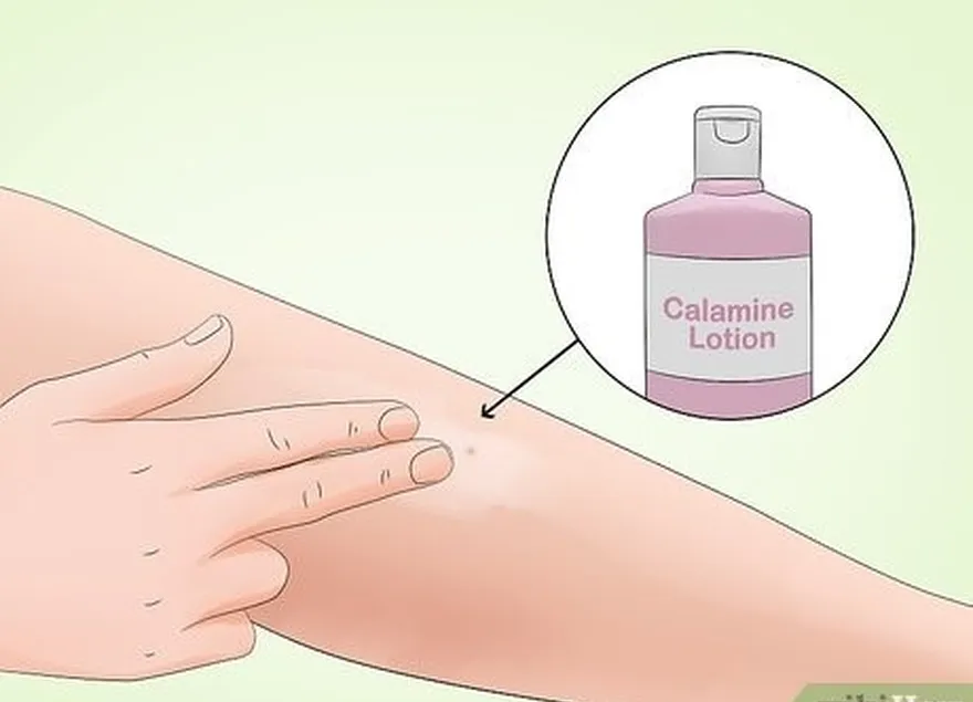 étape 5 : appliquer une lotion à la calamine...